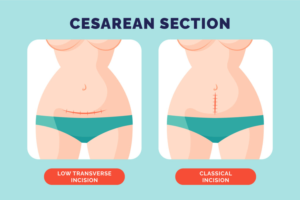 C-Section ways of giving birth