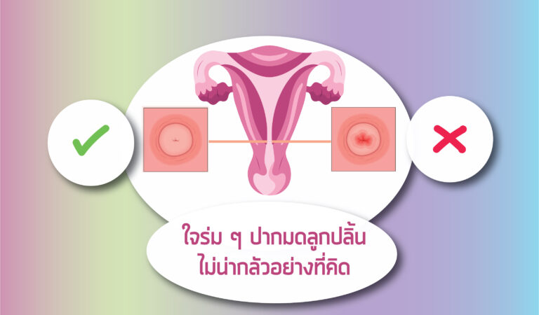 cervical-ectropion-article-ปากมดลูกปลิ้น