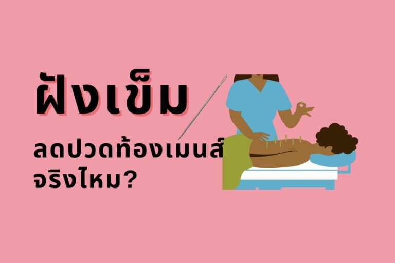 ฝังเข็ม